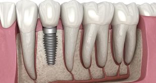 سه سایت مطرح ایمپلنت دندان